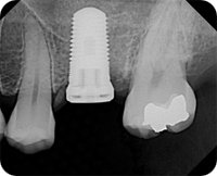implantın röntgen görüntüsü
