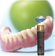 implant