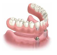 full implant